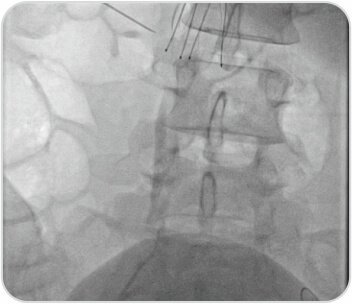 A Challenging Case of Left Leg DVT in A Young Girl