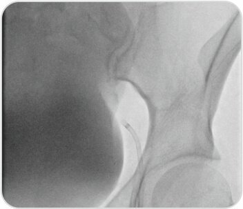 A Challenging Case of Left Leg DVT in A Young Girl