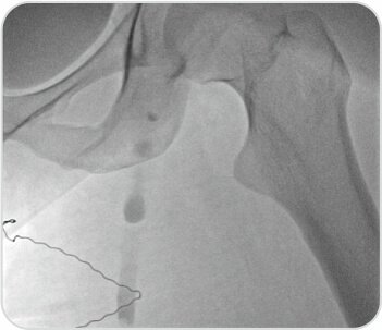 A Challenging Case of Left Leg DVT in A Young Girl