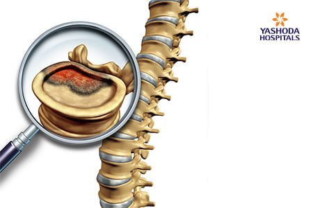 Chordoma Causes