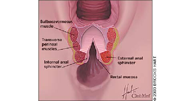 Chronic fourth-degree tear-banner