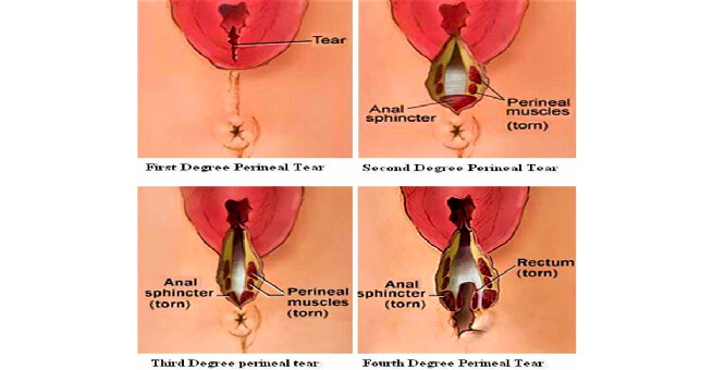 Chronic fourth-degree tear1