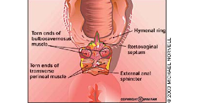 Chronic fourth-degree tear2