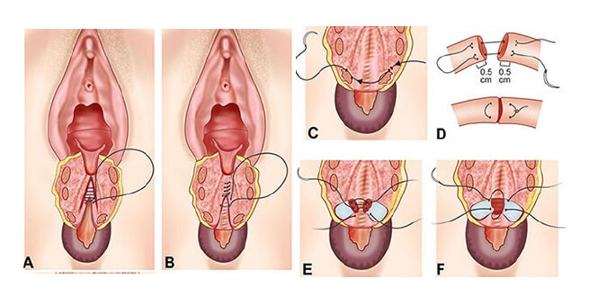 Chronic fourth-degree tear3