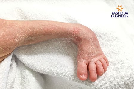 Clubfoot: Symptoms, Risk Factors and Complications