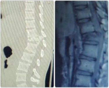 Pre op CT and MRI images showing unstable D12 burst fracture with retropulsion of fragment compromising the cord