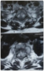 MRI – D1,D2 involved with complete collapse of D2 collection compressing the cord