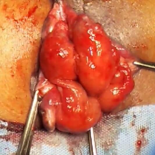 Delorme’s procedure hemorrhoidectomy