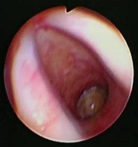 Bronchoscopic Management