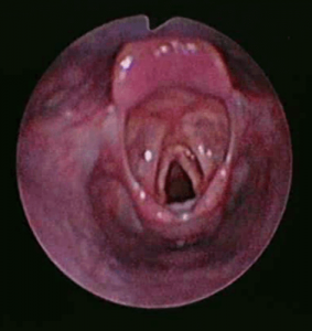 Bronchoscopic Management