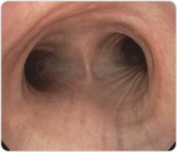 EBUS+TBNA for Diagnosis of Tuberculosis / Sarcoidosis