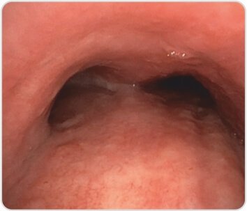 EBUS+TBNA for Diagnosis of Tuberculosis / Sarcoidosis