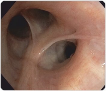 EBUS+TBNA for Diagnosis of Tuberculosis / Sarcoidosis