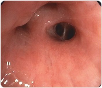 EBUS+TBNA for Diagnosis of Tuberculosis / Sarcoidosis