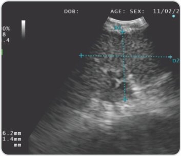 EBUS+TBNA for Diagnosis of Tuberculosis / Sarcoidosis