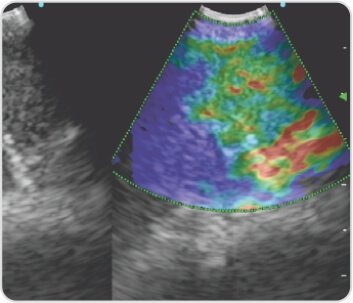 EBUS+TBNA for Diagnosis of Tuberculosis / Sarcoidosis