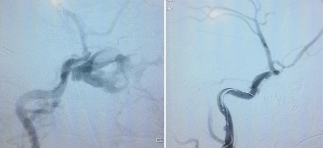 Embolization of the Carotico Cavernous Fistula