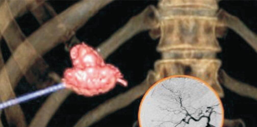 Embolization of the Carotico