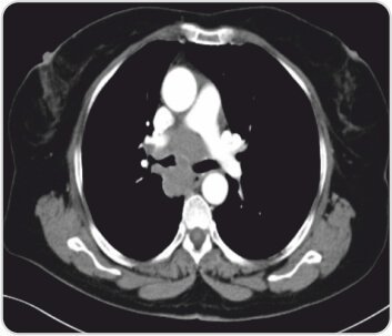 Endobronchial Ultrasound +Transbronchial Needle Aspiration for Lung Tumour