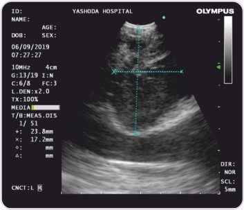 Endobronchial Ultrasound +Transbronchial Needle Aspiration for Lung Tumour