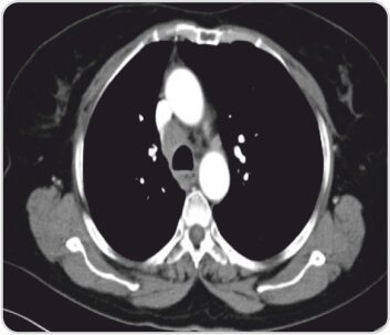 Endobronchial Ultrasound +Transbronchial Needle Aspiration for Lung Tumour