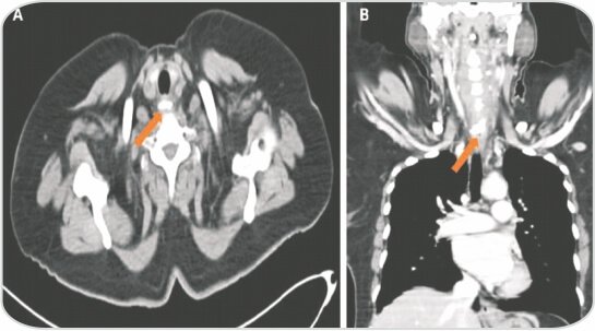 Endoscopic Removal of Foreign Body