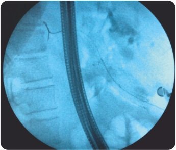 Endoscopic Ultrasound Guided Choledocho -Duodenostomy