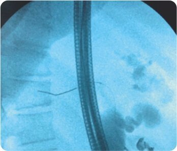 Endoscopic Ultrasound Guided Choledocho -Duodenostomy