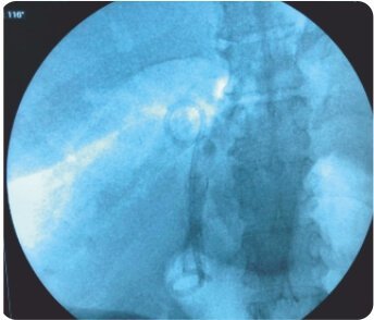 Endoscopic Ultrasound Guided Choledocho -Duodenostomy