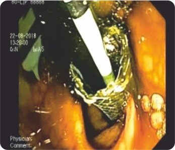 Endoscopic Ultrasound Guided Choledocho -Duodenostomy