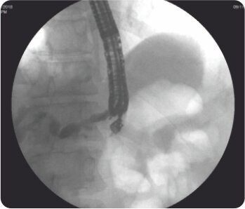 Endoscopic Ultrasound Guided Hepatico - Gastrostomy