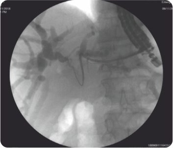 Endoscopic Ultrasound Guided Hepatico - Gastrostomy