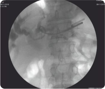 Endoscopic Ultrasound Guided Hepatico - Gastrostomy