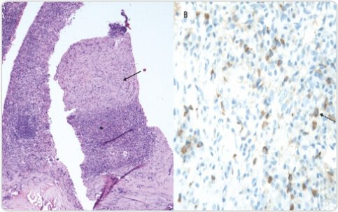 FDG PETCT in Isolated Mediastinal IgG4