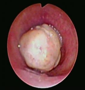 Bronchoscopic Management