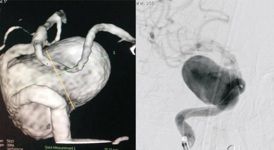 Flow Diverter Placement for Giant Cavernous ICA Aneurysm