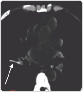 Fluoroscopy Guided Removal of Dislodged IV Canula Shaft