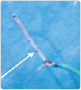 Fluoroscopy Guided Removal of Dislodged IV Canula Shaft