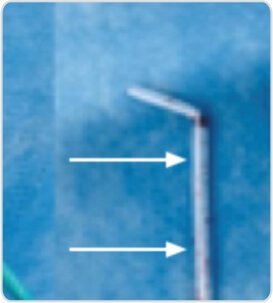 Fluoroscopy Guided Removal of Dislodged IV Canula Shaft