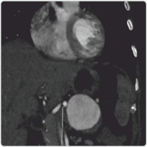 Giant Splenic Artery Aneurysm Treated by (spleen Sparing) Endovascular Embolization