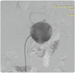 Giant Splenic Artery Aneurysm Treated by (spleen Sparing) Endovascular Embolization