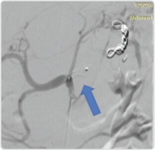 Giant Splenic Artery Aneurysm Treated by (spleen Sparing) Endovascular Embolization