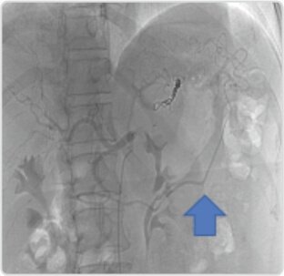 Giant Splenic Artery Aneurysm Treated by (spleen Sparing) Endovascular Embolization