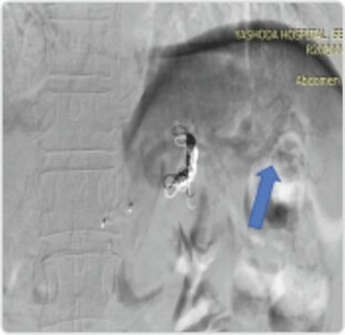 Giant Splenic Artery Aneurysm Treated by (spleen Sparing) Endovascular Embolization