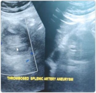 Giant Splenic Artery Aneurysm Treated by (spleen Sparing) Endovascular Embolization