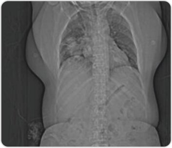 Granulomatosis with Polyangiitis Successfully Maintained on Rituximab Biosimilar