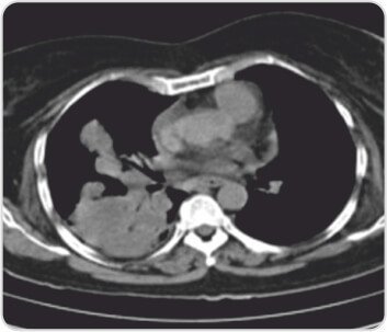 Granulomatosis with Polyangiitis Successfully Maintained on Rituximab Biosimilar