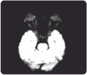 Granulomatosis with Polyangiitis Successfully Maintained on Rituximab Biosimilar