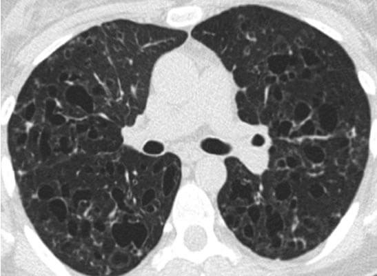 HRCT chest at presentation