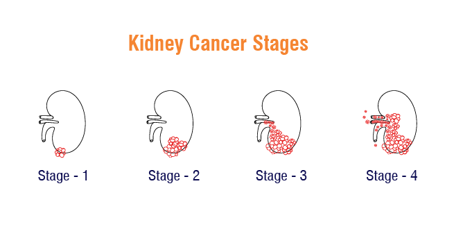 Kidney Cancer_Body 2